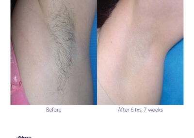 Laser Hair Removal