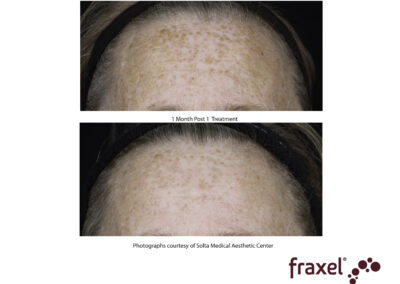 0766-Fraxel1927_HiRes